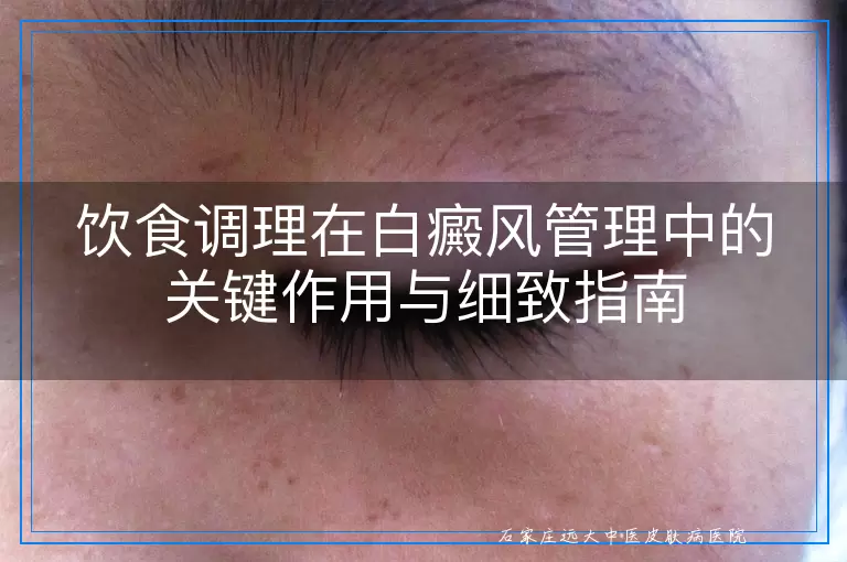 饮食调理在白癜风管理中的关键作用与细致指南