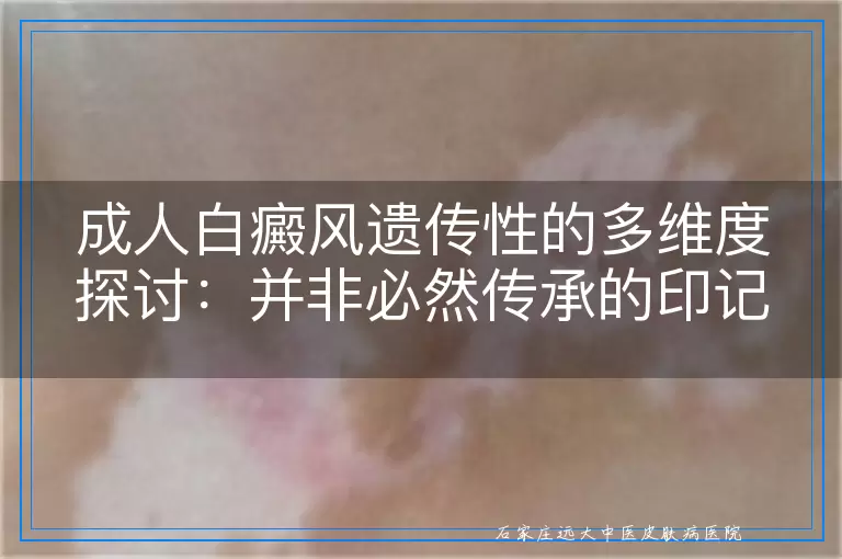 成人白癜风遗传性的多维度探讨：并非必然传承的印记