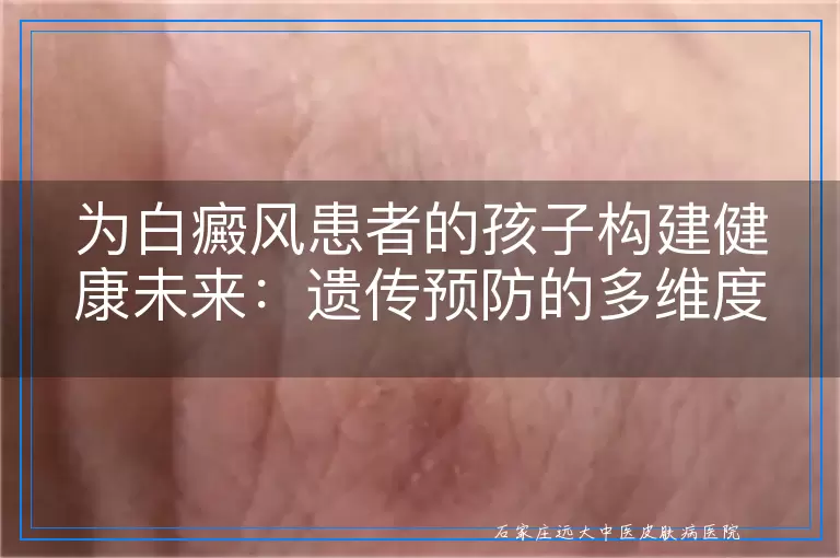 为白癜风患者的孩子构建健康未来：遗传预防的多维度指南