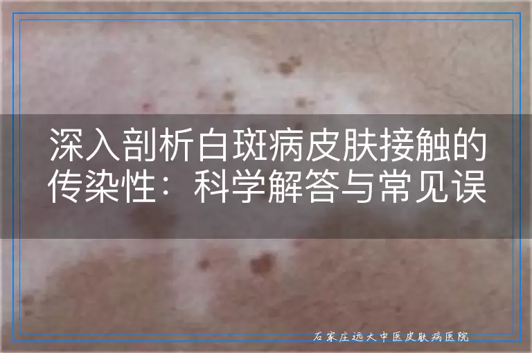 深入剖析白斑病皮肤接触的传染性：科学解答与常见误区