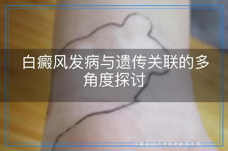 白癜风发病与遗传关联的多角度探讨
