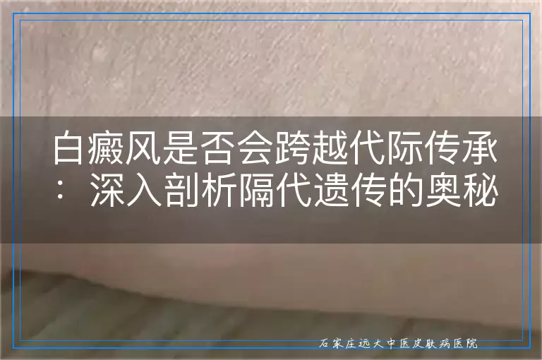 白癜风是否会跨越代际传承：深入剖析隔代遗传的奥秘
