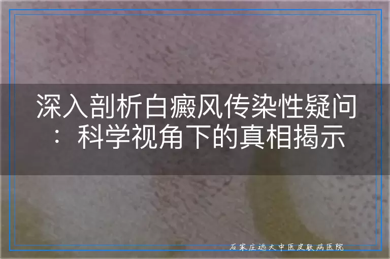 深入剖析白癜风传染性疑问：科学视角下的真相揭示