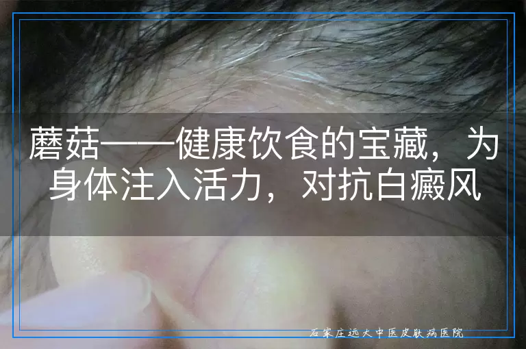 蘑菇——健康饮食的宝藏，为身体注入活力，对抗白癜风有奇效