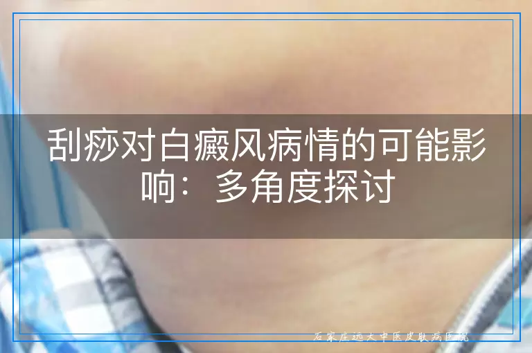 刮痧对白癜风病情的可能影响：多角度探讨