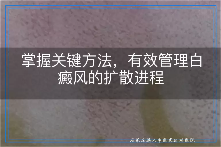 掌握关键方法，有效管理白癜风的扩散进程