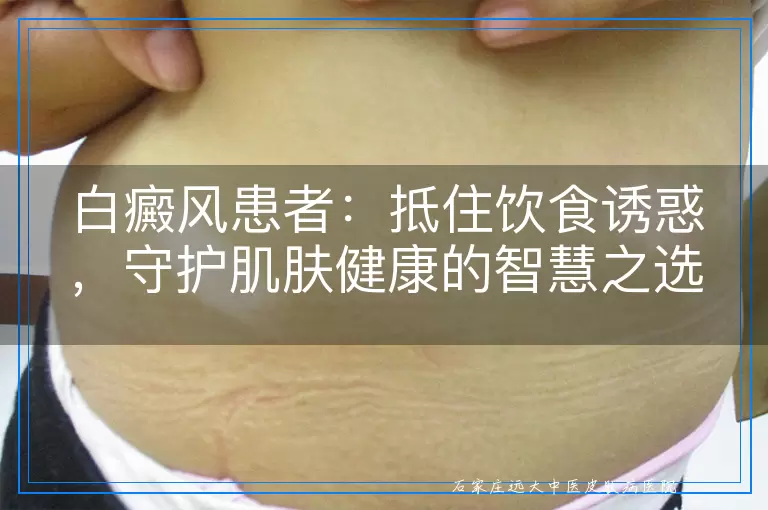 白癜风患者：抵住饮食诱惑，守护肌肤健康的智慧之选