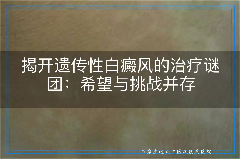 揭开遗传性白癜风的治疗谜团：希望与挑战并存