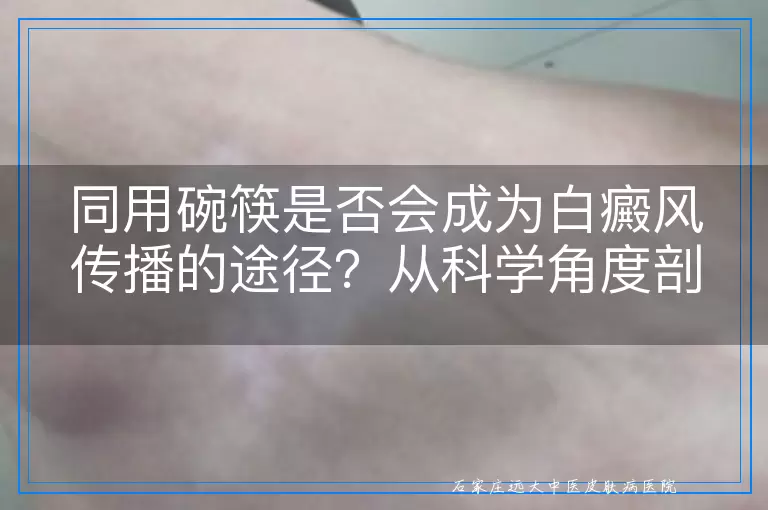 同用碗筷是否会成为白癜风传播的途径？从科学角度剖析这一疑虑