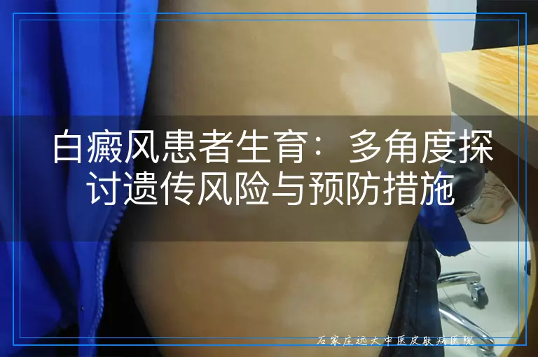 白癜风患者生育：多角度探讨遗传风险与预防措施