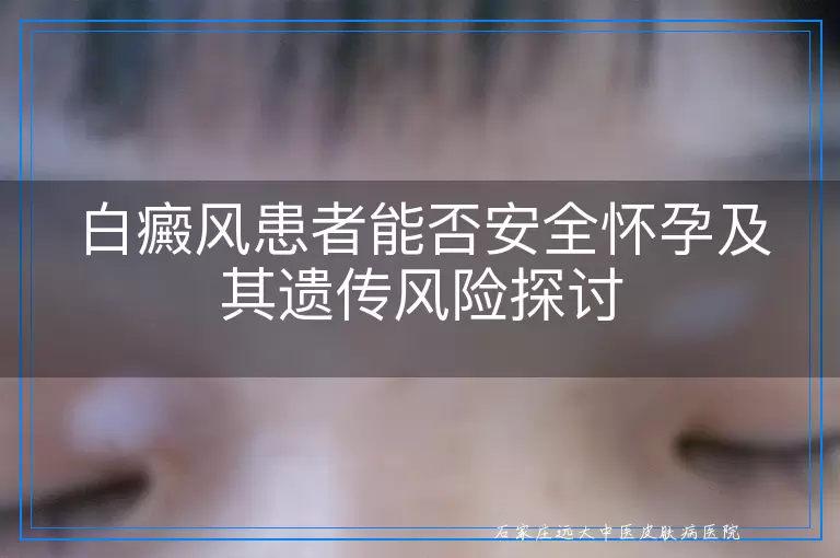白癜风患者能否安全怀孕及其遗传风险探讨