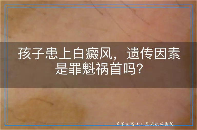 孩子患上白癜风，遗传因素是罪魁祸首吗？
