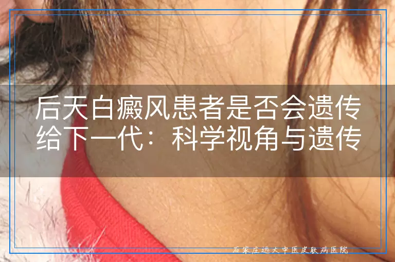 后天白癜风患者是否会遗传给下一代：科学视角与遗传机制探讨