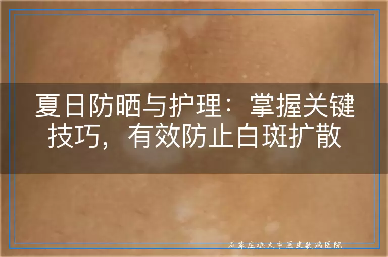夏日防晒与护理：掌握关键技巧，有效防止白斑扩散