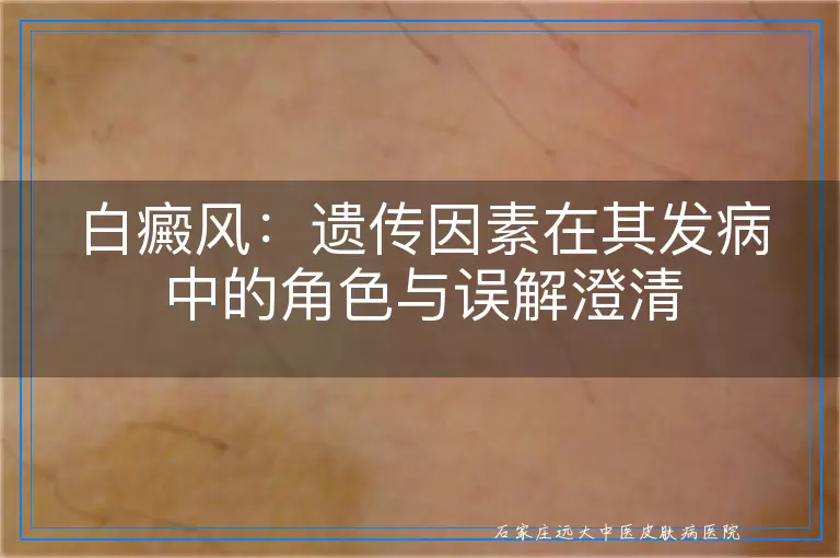 白癜风：遗传因素在其发病中的角色与误解澄清