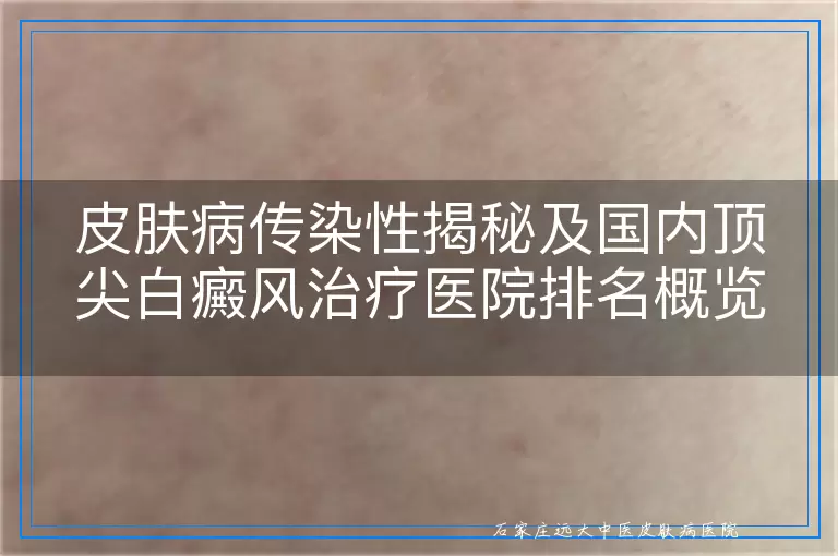 皮肤病传染性揭秘及国内顶尖白癜风治疗医院排名概览