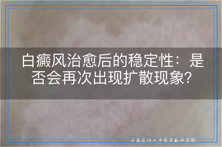白癜风治愈后的稳定性：是否会再次出现扩散现象？
