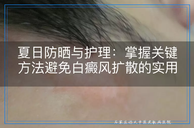 夏日防晒与护理：掌握关键方法避免白癜风扩散的实用指南