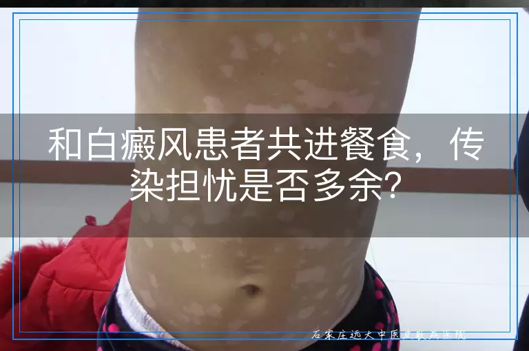 和白癜风患者共进餐食，传染担忧是否多余？