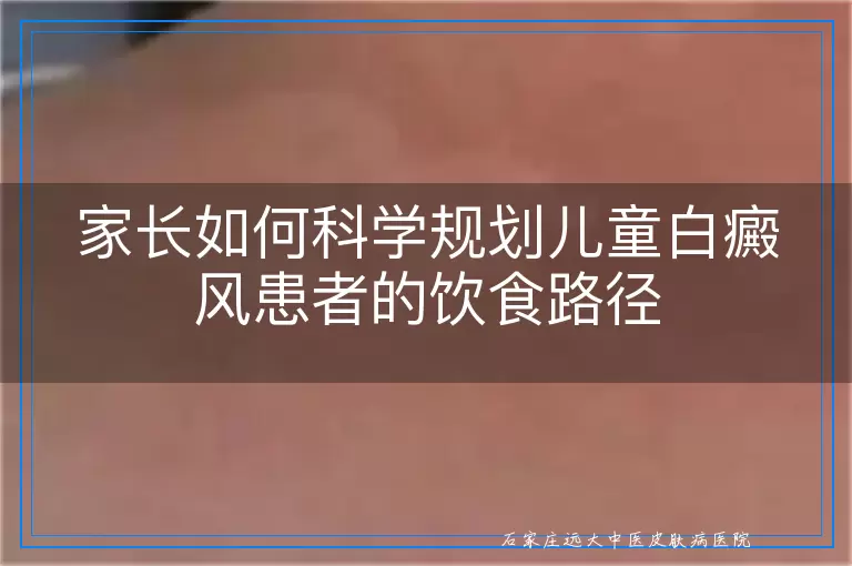 家长如何科学规划儿童白癜风患者的饮食路径