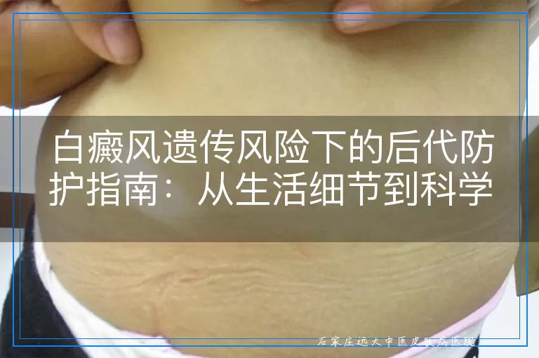 白癜风遗传风险下的后代防护指南：从生活细节到科学管理的综合建议
