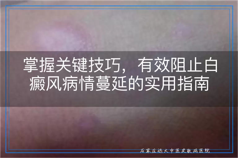 掌握关键技巧，有效阻止白癜风病情蔓延的实用指南
