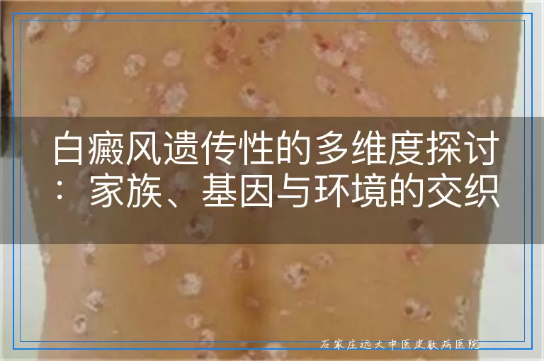 白癜风遗传性的多维度探讨：家族、基因与环境的交织影响