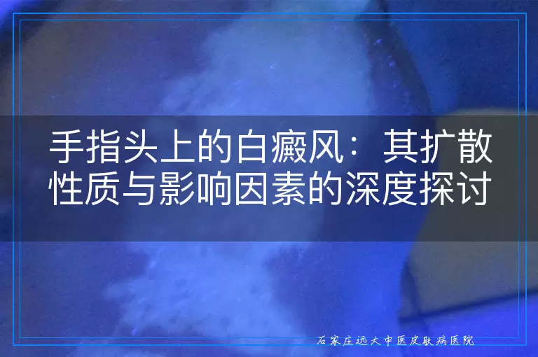 手指头上的白癜风：其扩散性质与影响因素的深度探讨