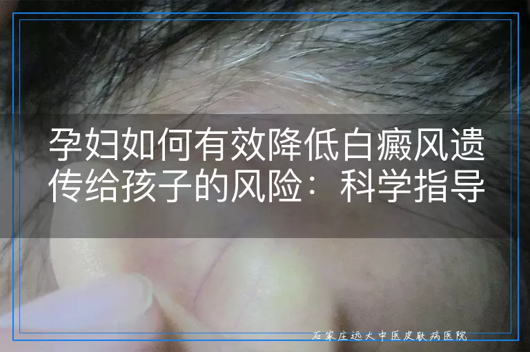 孕妇如何有效降低白癜风遗传给孩子的风险：科学指导与实践建议