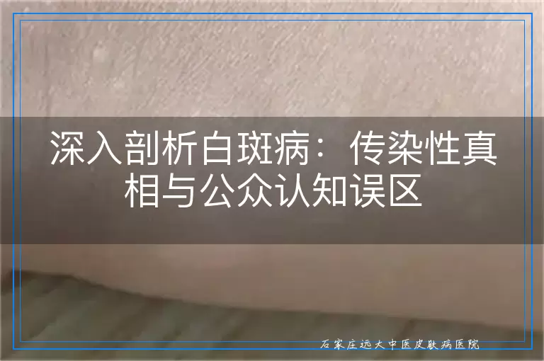 深入剖析白斑病：传染性真相与公众认知误区