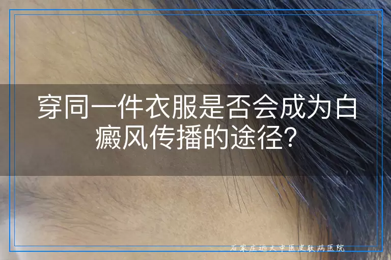 穿同一件衣服是否会成为白癜风传播的途径？