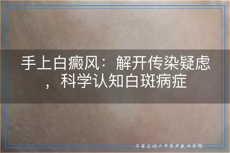 手上白癜风：解开传染疑虑，科学认知白斑病症