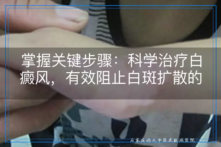 掌握关键步骤：科学治疗白癜风，有效阻止白斑扩散的实用指南
