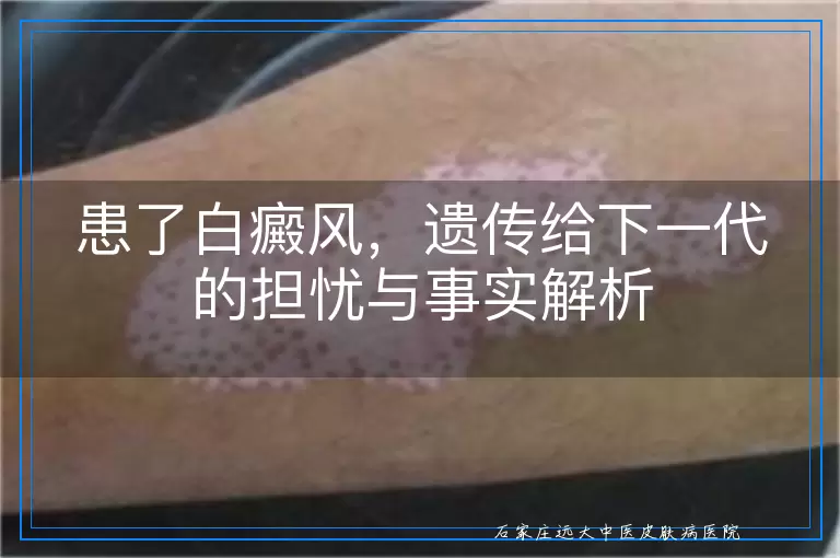 患了白癜风，遗传给下一代的担忧与事实解析