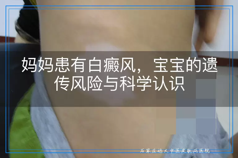 妈妈患有白癜风，宝宝的遗传风险与科学认识