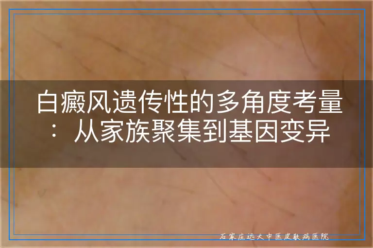 白癜风遗传性的多角度考量：从家族聚集到基因变异