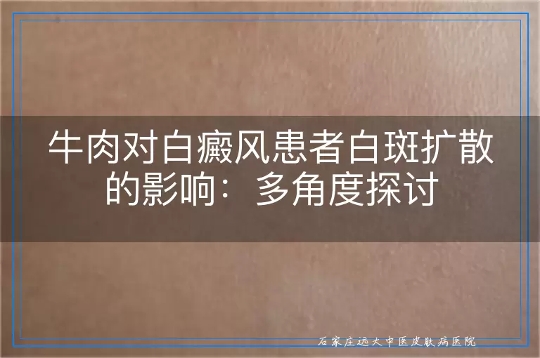 牛肉对白癜风患者白斑扩散的影响：多角度探讨