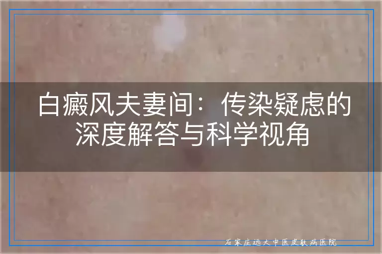 白癜风夫妻间：传染疑虑的深度解答与科学视角