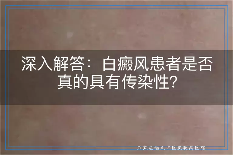 深入解答：白癜风患者是否真的具有传染性？