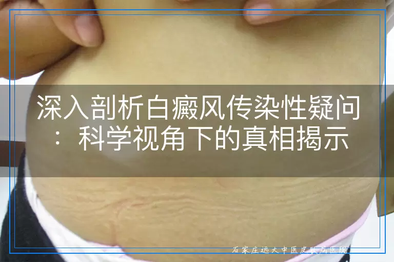 深入剖析白癜风传染性疑问：科学视角下的真相揭示