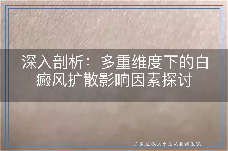 深入剖析：多重维度下的白癜风扩散影响因素探讨