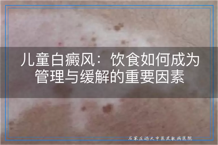 儿童白癜风：饮食如何成为管理与缓解的重要因素
