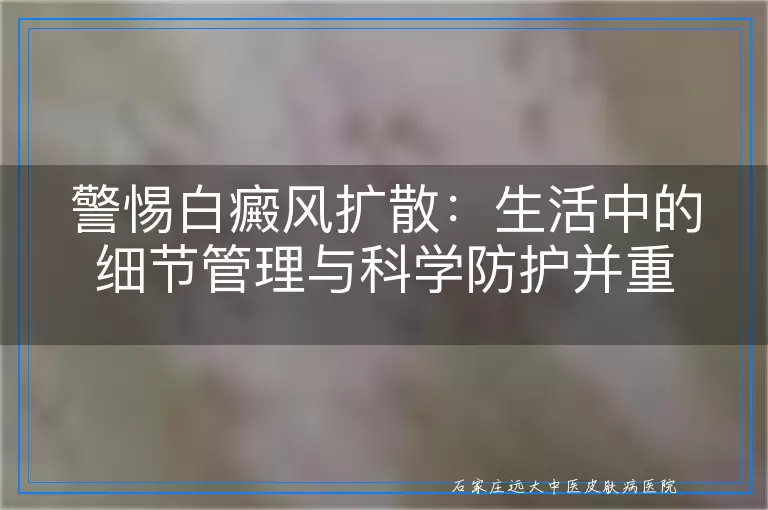 警惕白癜风扩散：生活中的细节管理与科学防护并重