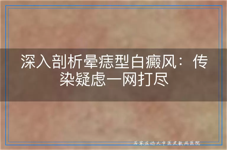 深入剖析晕痣型白癜风：传染疑虑一网打尽