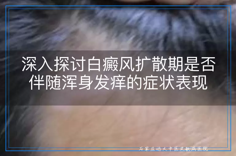 深入探讨白癜风扩散期是否伴随浑身发痒的症状表现