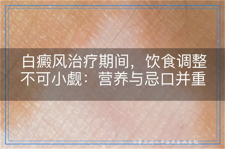 白癜风治疗期间，饮食调整不可小觑：营养与忌口并重