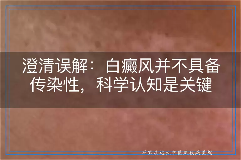澄清误解：白癜风并不具备传染性，科学认知是关键