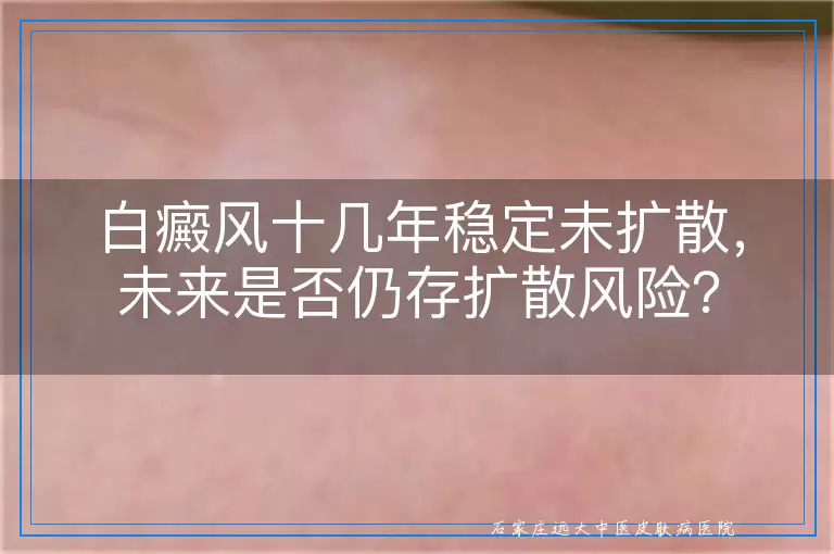 白癜风十几年稳定未扩散，未来是否仍存扩散风险？