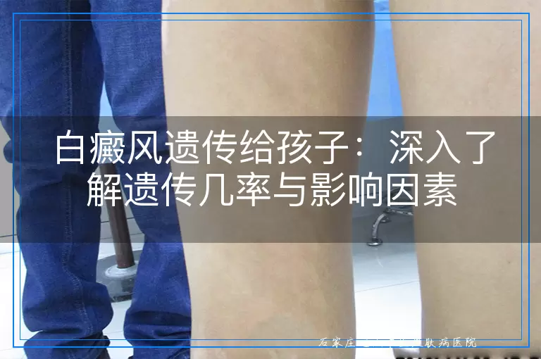 白癜风遗传给孩子：深入了解遗传几率与影响因素