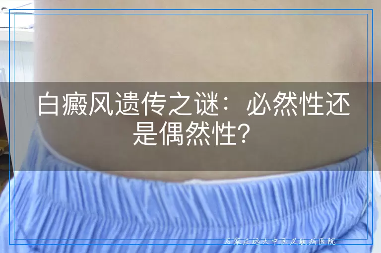 白癜风遗传之谜：必然性还是偶然性？